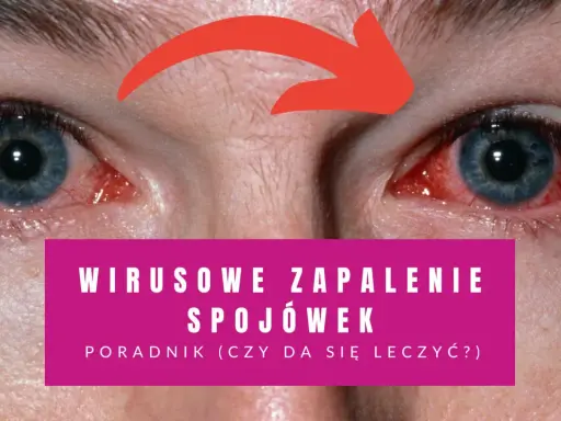Czerwone, podrażnione oczy z widocznymi naczynkami. Tekst informuje o wirusowym zapaleniu spojówek i poradniku leczenia.