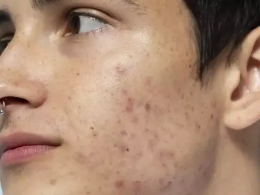 Primo piano del volto di un giovane con piercing al naso, che mostra le imperfezioni della pelle come brufoli e macchie.