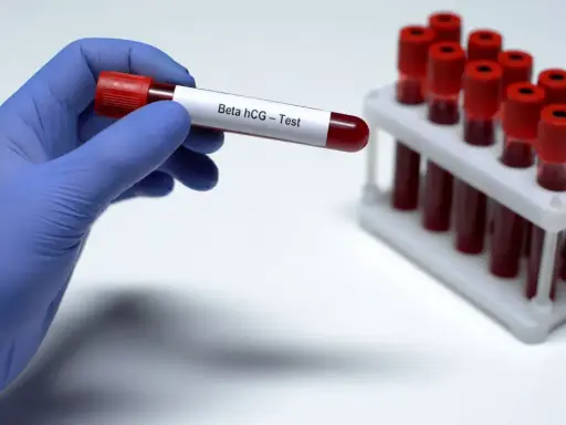Ręka w niebieskiej rękawiczce trzyma probówkę z krwią do badania Beta hCG – test ciążowy z krwi. W tle stojak z innymi próbkami.