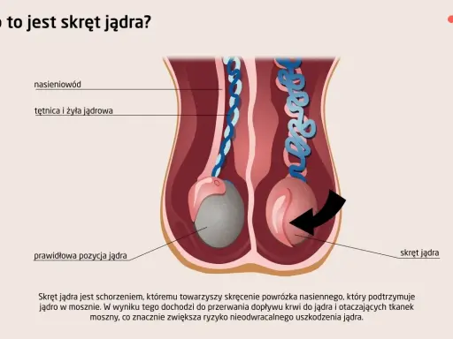 Ilustracja pokazuje skręt jądra, stanowiący przyczynę silnego bólu jądra, gdzie powrózek nasienny ulega skręceniu, blokując dopływ krwi.