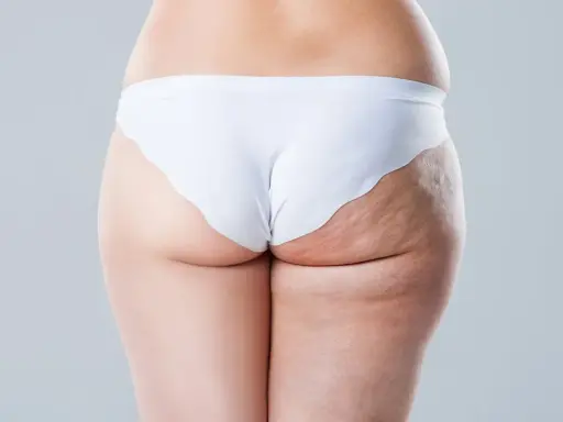 Vue arrière d'une femme en culotte blanche, montrant la cellulite sur sa cuisse.