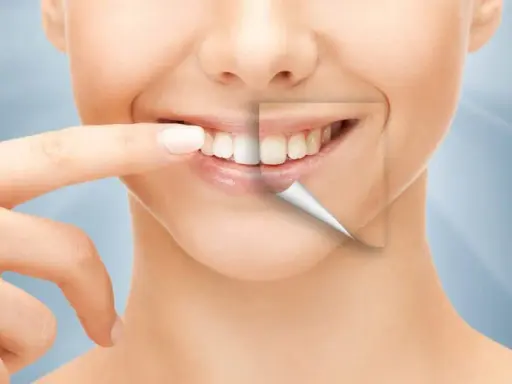 Ile kosztuje Hollywood Smile: kompletny cennik zabiegów w 2025 roku