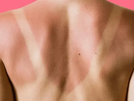 Schiena con evidente abbronzatura a strisce, segno di una giornata al sole con indumenti che hanno lasciato la pelle scoperta in alcune zone.
