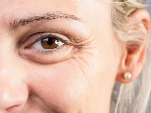 Gros plan sur un œil marron, avec des rides marquées. Une cuillère froide sur les yeux pour soulager les cernes.