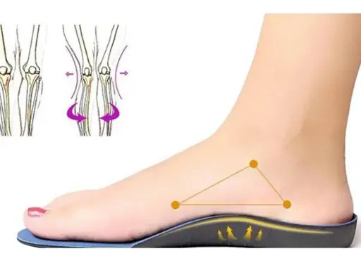 Un pied avec une semelle orthopédique, montrant le soutien. Le podologue utilise ces semelles pour corriger la posture.