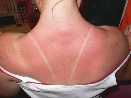 Dos lignes claires sur un dos rouge vif, témoignage d'un coup de soleil. Pour savoir comment faire dérougir un coup de soleil, il faut hydrater et apaiser la peau.