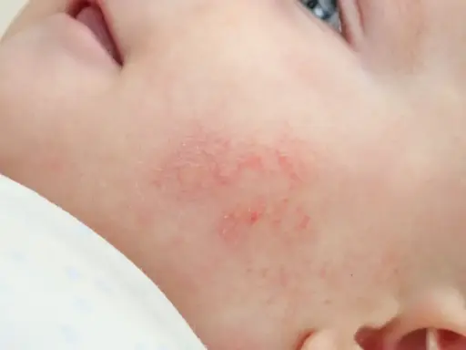 Un petit bouton rouge sur la joue d'un nourrisson, signe d'une peau sensible.