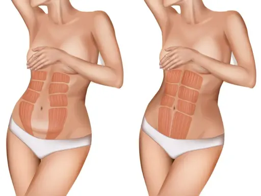 Vergleich zweier Bäuche: links ein Bauch nach Schwangerschaft mit deutlicher Trennung der Bauchmuskeln, rechts ein straffer Bauch mit sichtbaren Muskelpaketen.