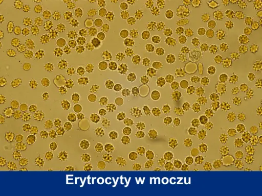 Mikroskopowy obraz moczu z licznymi erytrocytami, niektóre o zmienionym kształcie, sugerujące obecność leukocytów.