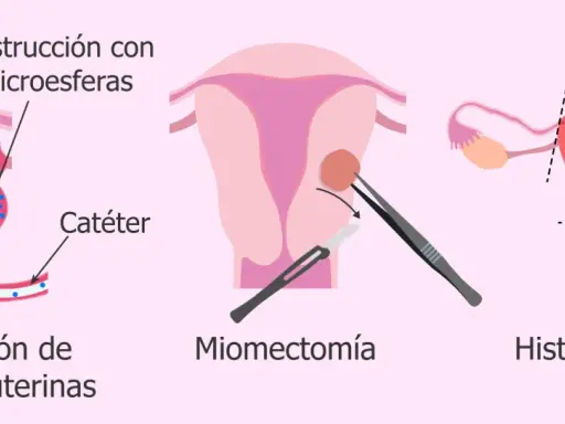 Ilustración de tratamientos para el mioma uterino: embolización, miomectomía y<bos> Histerectomía.