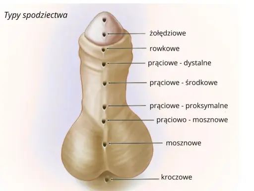 Ilustracja przedstawia typy spodziectwa, czyli wady rozwojowe cewki moczowej. Różne lokalizacje ujścia cewki mogą wpływać na obniżenie cewki moczowej objawy.