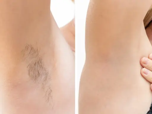 Depilacja laserowa: Skóra po zabiegu co zobaczysz i poczujesz?