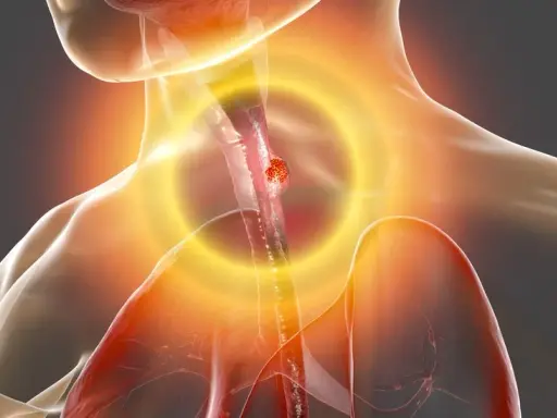 Cáncer de esófago: síntomas clave que no debes ignorar. ¿Los conoces?