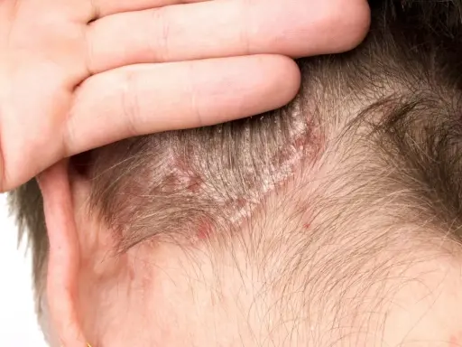 Main d'une personne touchant son cuir chevelu, révélant des plaques rouges et des squames cheveux.