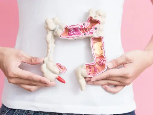Model jelita grubego z widocznymi zmianami, symbolizującymi potencjalne przyczyny raka jelita grubego.