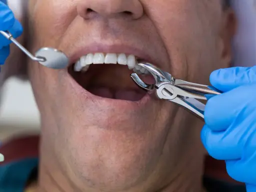 Ból po wyrwaniu zęba: ile trwa, co normą i kiedy do dentysty?