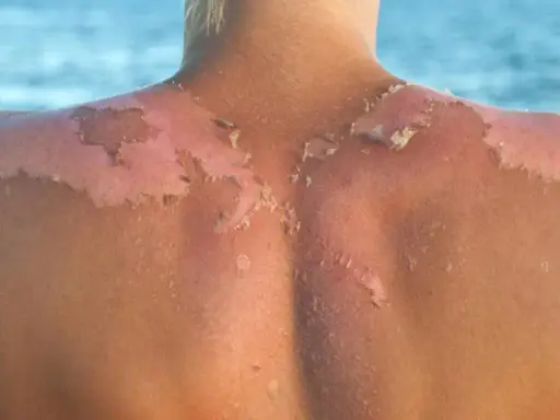 Piel descascarada por quemadura solar. Descubre cómo detener el peeling tras la insolación y aliviar tu piel.