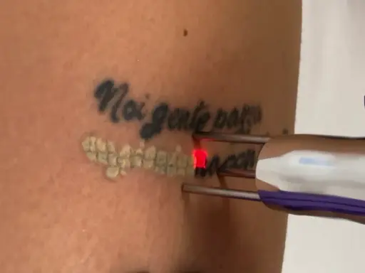Rimozione tatuaggio con laser: un fascio rosso illumina la pelle mentre si procede a togliere il disegno.