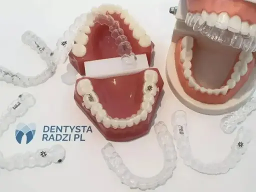 Modele szczęk z widocznymi alignerami. Te przezroczyste nakładki to nowoczesne rozwiązanie do prostowania zębów.