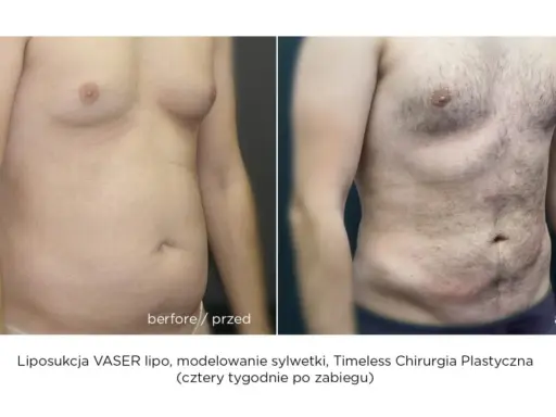 Liposukcja: Modelowanie sylwetki, nie odchudzanie. Poznaj fakty!