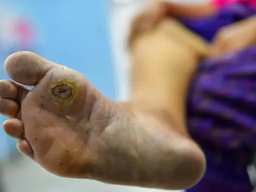 Pied diabétique grade 3 avec une plaie ouverte sur la plante du pied, nécessitant des soins médicaux urgents.