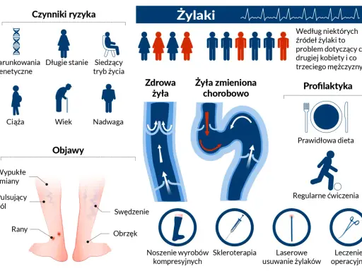 Jak dbać o żyły? Infografika przedstawia czynniki ryzyka żylaków, objawy, zdrową i chorą żyłę, a także profilaktykę: dietę, ćwiczenia, wyroby kompresyjne i metody leczenia.