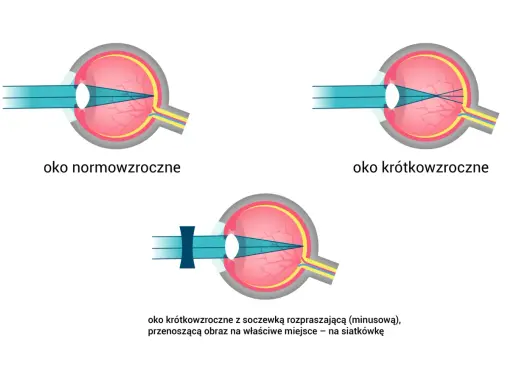 Ilustracja oka: normowzroczne, krótkowzroczne i krótkowzroczne z soczewką korygującą.