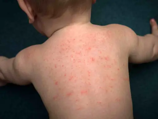 Schiena di neonato con eruzione cutanea rossa diffusa, forse dovuta a sudorina sulla pelle.
