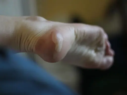 Gros plan sur un pied avec une phlyctène sur le talon, nécessitant un traitement.