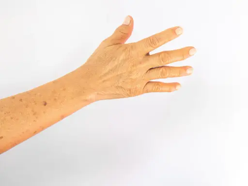 Bras avec des taches solaires, marques du temps et du soleil sur la peau.