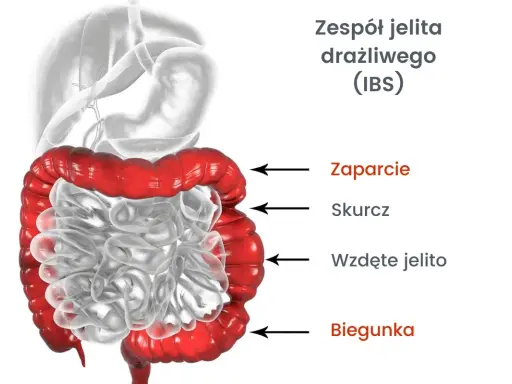 Jelito drażliwe: Objawy, typy, czerwone flagi. Kiedy do lekarza?