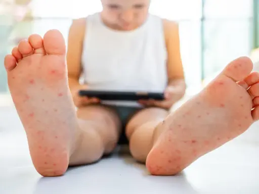 Pies de niño con erupción roja, posible síntoma de rubeola.