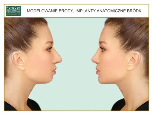 Przed i po zabiegu modelowania brody. Genioplastyka poprawiająca profil twarzy.