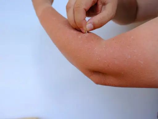 Main d'une personne qui retire des lambeaux de peau qui pèle sur son bras, signe d'un coup de soleil.