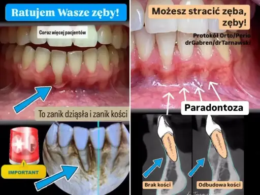 Zaniedbane dziąsła i kość to paradontoza. Leczenie recesji dziąseł i odbudowa kości to klucz do ratowania zębów.