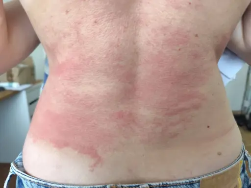 Le dos présente des rougeurs et des plaques, signe d'une réaction cutanée. Il est urgent de trouver une solution pour calmer les démangeaisons.