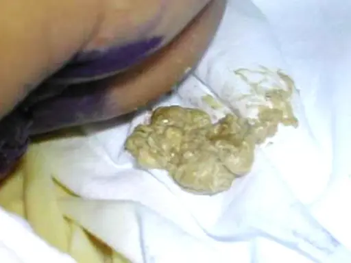Feci grasse e giallastre, indicative di steatorrea, su un pannolino. Le cause possono essere molteplici.