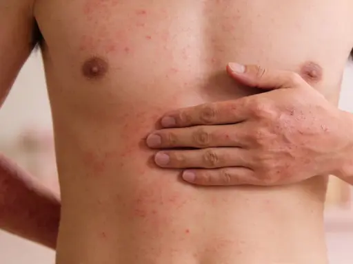 Torso e braccia di una persona con estese irritazioni cutanee rosse e pruriginose.
