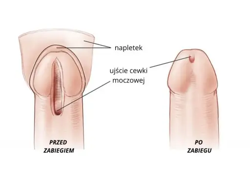Przed i po zabiegu: ujście cewki moczowej u mężczyzn, z napletkiem.