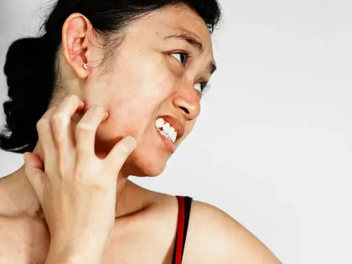 Une femme se gratte le cou et le visage, visiblement gênée par une peau très sèche et des démangeaisons.