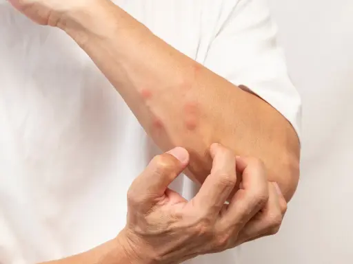 Un bras couvert de boutons rouges, la personne se gratte pour savoir comment ne pas se gratter les boutons de moustiques.
