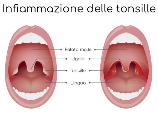 Illustrazione che mostra un'infiammazione delle tonsille, comune nel mal di gola dei bambini. Le tonsille gonfie e rosse sono visibili.