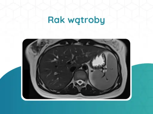 Przekrój tomografii komputerowej wątroby z widocznym guzem.