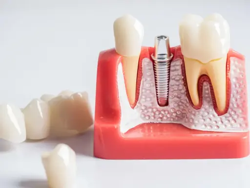 Ból po wyrwaniu ósemki: Ile trwa, co jest normą i kiedy do dentysty?