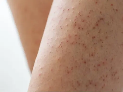 Gros plan sur une peau présentant des petites bosses rouges, typiques de la kératose pilaire.