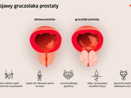 Ilustracja porównuje zdrową prostatę z gruczolakiem, pokazując objawy takie jak słaby i przerywany strumień moczu u mężczyzn.