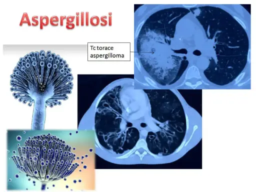 Aspergillosi: immagini di Aspergillus e TAC polmonari che mostrano un aspergilloma. L'aspergillosi è contagiosa.