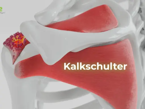 Kalkschulter: Ablagerungen im Schultergelenk. Was tun? Hier wird die Ursache der Schmerzen visualisiert.