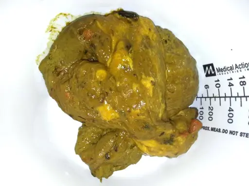Feci oleose, di colore giallo-verdastro, con residui visibili e una consistenza untuosa. Accanto, una scala graduata.