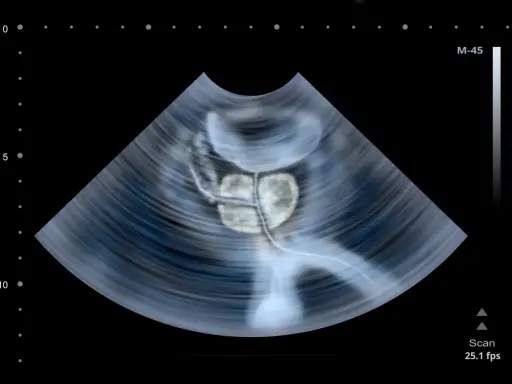 USG prostaty. Częste oddawanie moczu po operacji prostaty może być związane z różnymi czynnikami, które lekarz oceni.